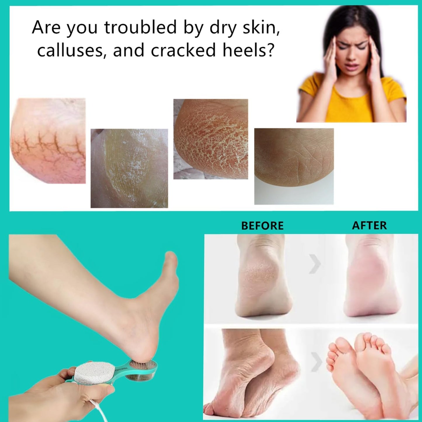 Foot File Callus Remover 5-in-1, 2 Pcs Feet Scraper Pedicure Tools with Pumice Stone, Scrubber Brush, Stainless Steel Foot Rasp and Sand Paper Debris Catcher, Multi Purpose, Cyan